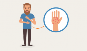 Dermatite: O que é, Tipos e tratamentos