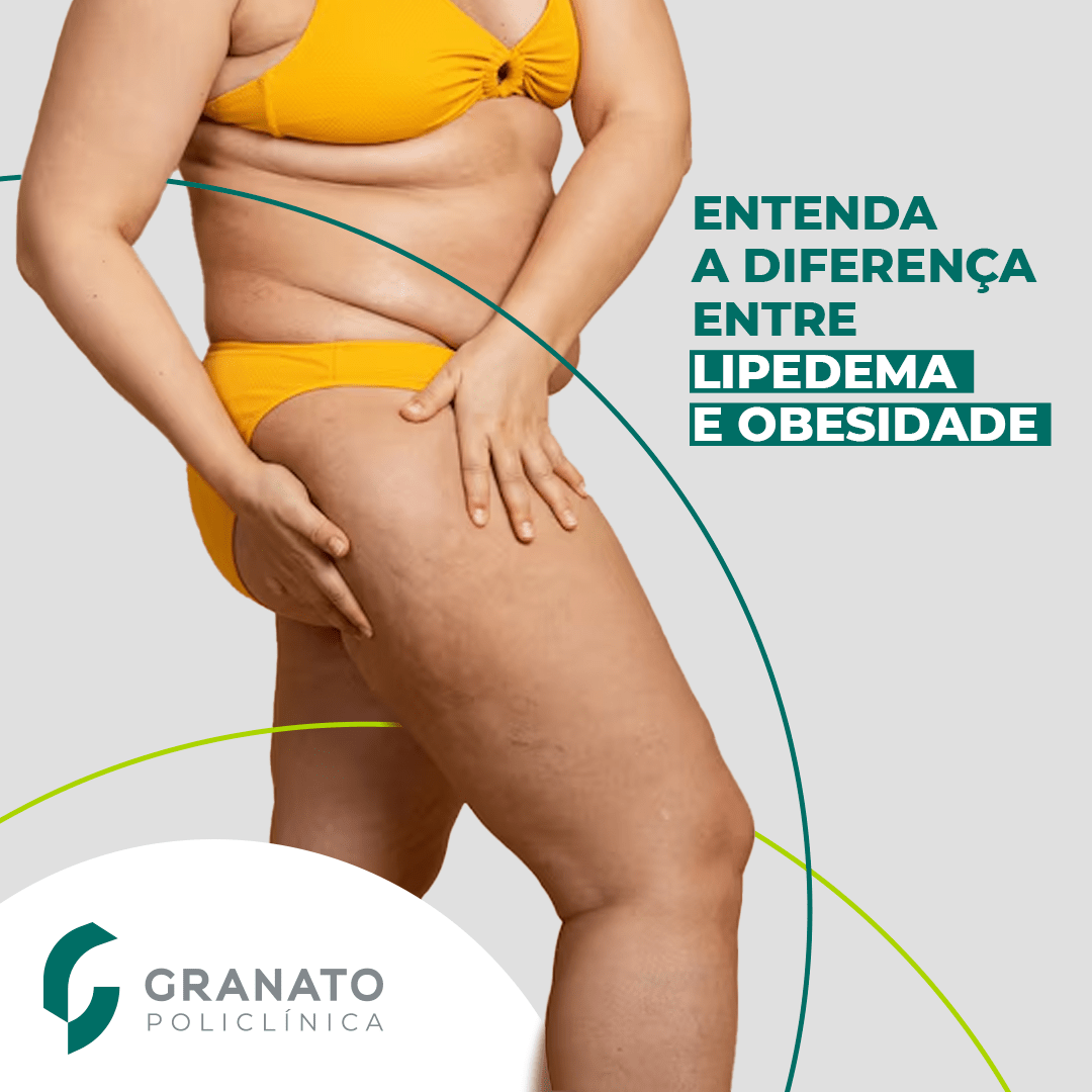 Lipedema x Obesidade: Entenda a diferença entre as duas doenças